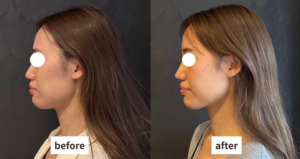 顔痩せ ビフォーアフター