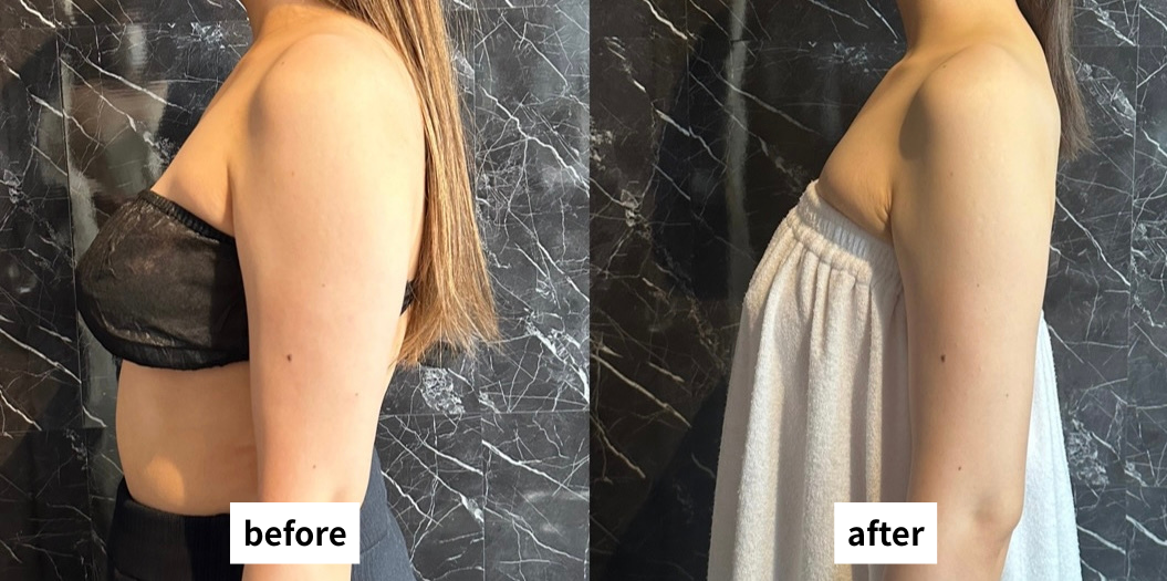 脚・二の腕痩せ ビフォーアフター